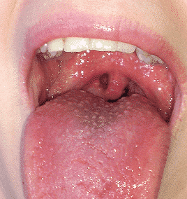 Blasen auf der Zunge