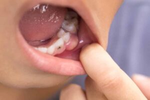 Zunge eiterbläschen nealkhoerr: Pusteln